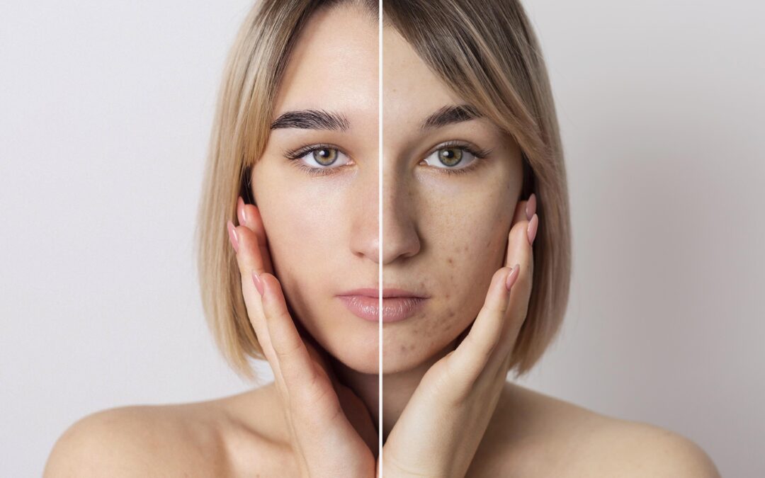 Understanding Pigmentation in Delhi: Causes, Treatments, and Prevention