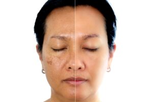 Pigmentation treatment in Delhi