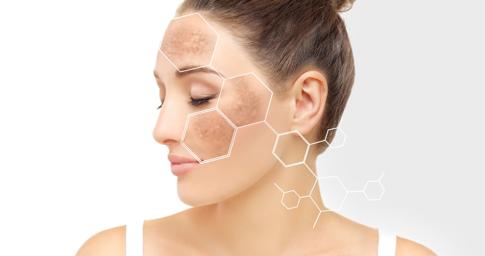 Pigmentation Treatment in Delhi: Your Guide to Flawless Skin